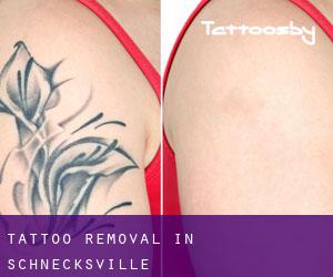 Tattoo Removal in Schnecksville
