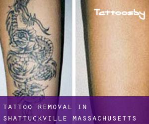 Tattoo Removal in Shattuckville (Massachusetts)