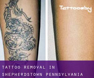 Tattoo Removal in Shepherdstown (Pennsylvania)