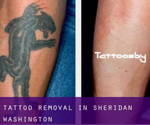 Tattoo Removal in Sheridan (Washington)