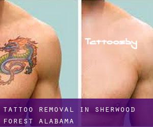Tattoo Removal in Sherwood Forest (Alabama)