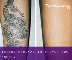 Tattoo Removal in Silver Bow County