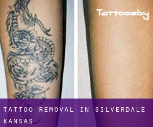 Tattoo Removal in Silverdale (Kansas)