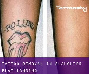 Tattoo Removal in Slaughter Flat Landing