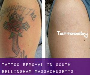 Tattoo Removal in South Bellingham (Massachusetts)