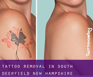 Tattoo Removal in South Deerfield (New Hampshire)