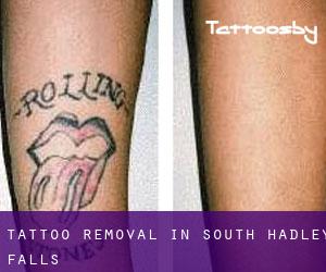 Tattoo Removal in South Hadley Falls