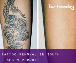 Tattoo Removal in South Lincoln (Vermont)