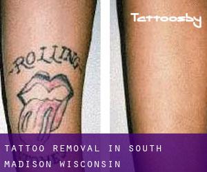 Tattoo Removal in South Madison (Wisconsin)