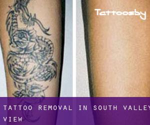 Tattoo Removal in South Valley View