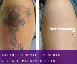 Tattoo Removal in South Village (Massachusetts)