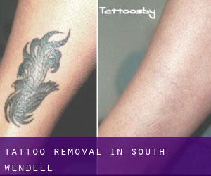 Tattoo Removal in South Wendell