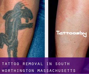Tattoo Removal in South Worthington (Massachusetts)