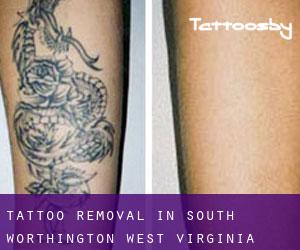 Tattoo Removal in South Worthington (West Virginia)