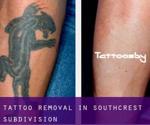 Tattoo Removal in Southcrest Subdivision