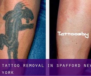 Tattoo Removal in Spafford (New York)