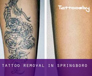 Tattoo Removal in Springboro