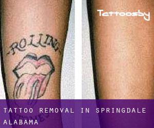 Tattoo Removal in Springdale (Alabama)