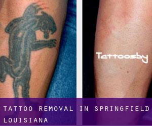 Tattoo Removal in Springfield (Louisiana)