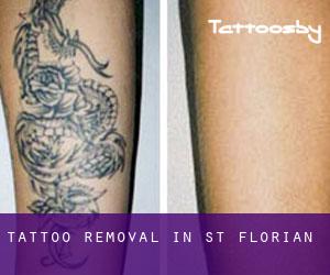 Tattoo Removal in St. Florian