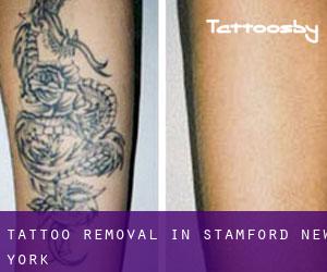Tattoo Removal in Stamford (New York)