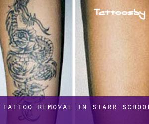 Tattoo Removal in Starr School