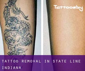 Tattoo Removal in State Line (Indiana)