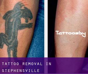 Tattoo Removal in Stephensville