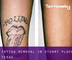 Tattoo Removal in Stuart Place (Texas)