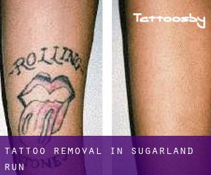Tattoo Removal in Sugarland Run