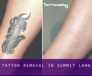 Tattoo Removal in Summit Lawn