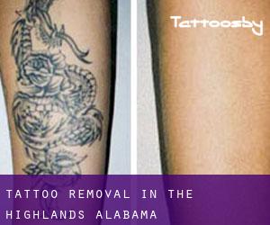 Tattoo Removal in The Highlands (Alabama)