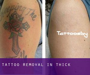 Tattoo Removal in Thick