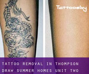 Tattoo Removal in Thompson Draw Summer Homes Unit Two