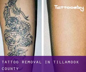 Tattoo Removal in Tillamook County