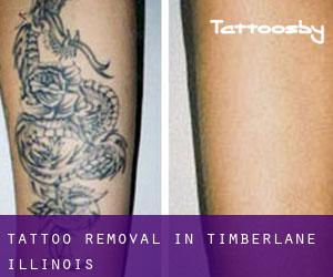 Tattoo Removal in Timberlane (Illinois)