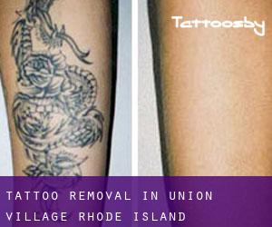 Tattoo Removal in Union Village (Rhode Island)