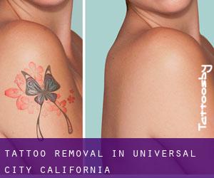 Tattoo Removal in Universal City (California)