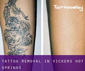 Tattoo Removal in Vickers Hot Springs