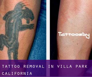 Tattoo Removal in Villa Park (California)