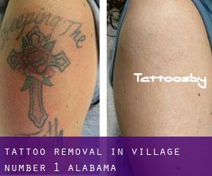 Tattoo Removal in Village Number 1 (Alabama)