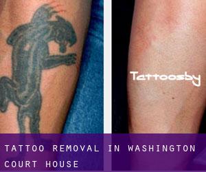Tattoo Removal in Washington Court House