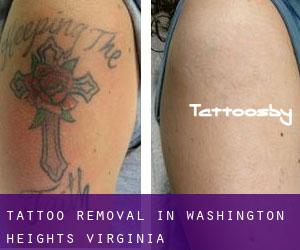 Tattoo Removal in Washington Heights (Virginia)