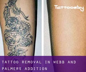 Tattoo Removal in Webb and Palmers Addition