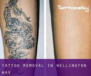 Tattoo Removal in Wellington Way
