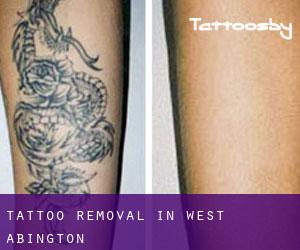 Tattoo Removal in West Abington