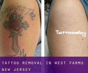 Tattoo Removal in West Farms (New Jersey)