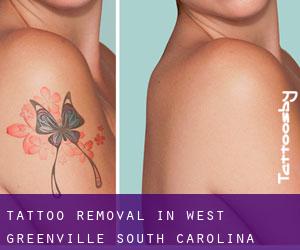 Tattoo Removal in West Greenville (South Carolina)