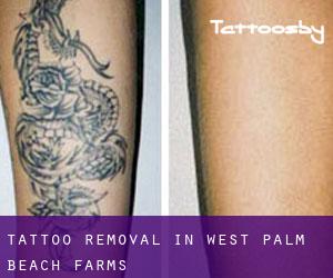Tattoo Removal in West Palm Beach Farms