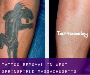 Tattoo Removal in West Springfield (Massachusetts)